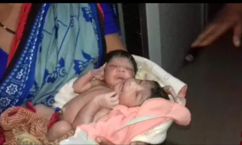 രണ്ട് തല, ഒരു ഉടല്‍, മൂന്ന് കൈ, രണ്ട് കാല്‍: ജനിച്ചത് അപൂര്‍വ സയാമീസ് ഇരട്ടകള്‍