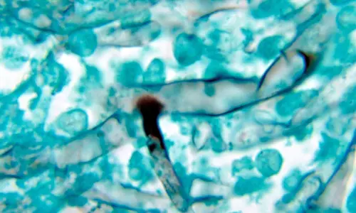 ബ്ലാക്ക് ഫംഗസ് മലപ്പുറത്തും