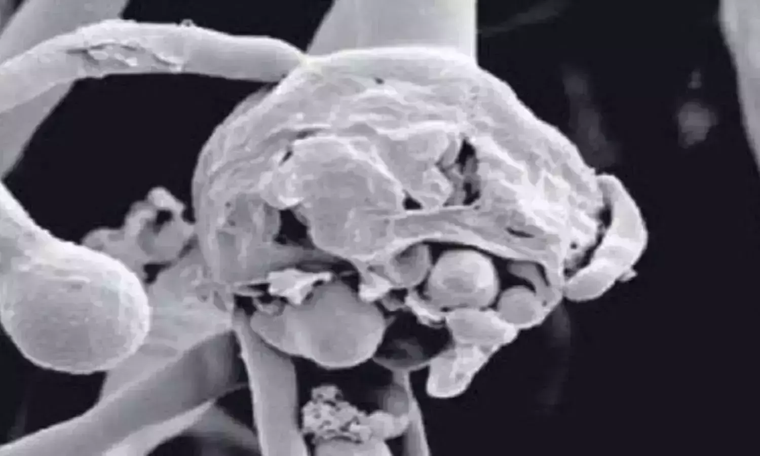 ബ്ലാക്ക് ഫംഗസിന് പിന്നാലെ വൈറ്റ് ഫംഗസും; കൂടുതല്‍ അപകടകാരിയെന്ന് വിദഗ്ധര്‍