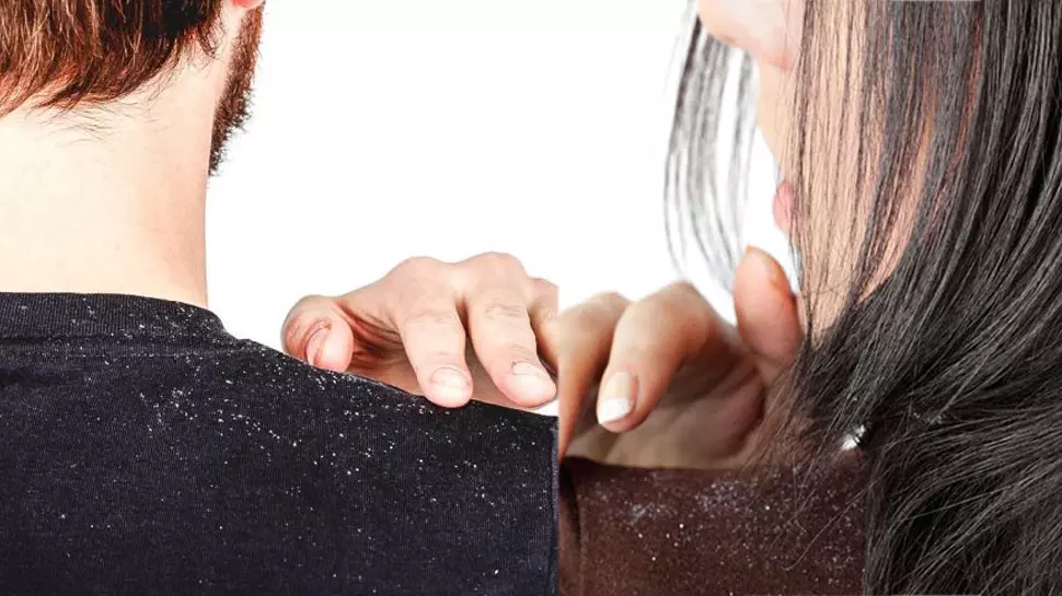 താരനാണോ പ്രശ്നം?, മാറ്റാൻ വഴിയുണ്ട്.. താരനാണോ പ്രശ്നം?, മാറ്റാൻ വഴിയുണ്ട്..