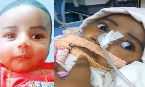 പതിനെട്ടു കോടിയുടെ മരുന്നിന് കാത്തിരുന്നില്ല; അപൂര്‍വ രോഗം ബാധിച്ച ഇമ്രാന്‍ വിടവാങ്ങി