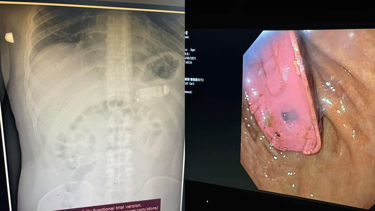 യുവാവ് ഫോൺ വിഴുങ്ങി; രണ്ടു മണിക്കൂർ നീണ്ട ശസ്ത്രക്രിയയിലൂടെ പുറത്തെടുത്തു യുവാവ് ഫോൺ വിഴുങ്ങി; രണ്ടു മണിക്കൂർ നീണ്ട ശസ്ത്രക്രിയയിലൂടെ പുറത്തെടുത്തു