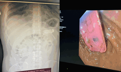 യുവാവ് ഫോൺ വിഴുങ്ങി; രണ്ടു മണിക്കൂർ നീണ്ട ശസ്ത്രക്രിയയിലൂടെ പുറത്തെടുത്തു