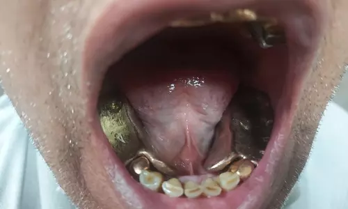 വായിലും സ്വർണം!!! സ്വർണ കള്ളക്കടത്തുകാരെ കയ്യോടെ പിടിച്ച് ഡൽഹി പൊലിസ്