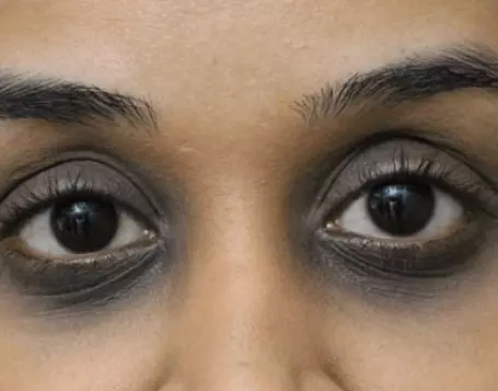 കണ്ണിനു ചുറ്റുമുള്ള കറുത്തപാടുകൾ മാറാൻ ഇതാ 5 വഴികൾ