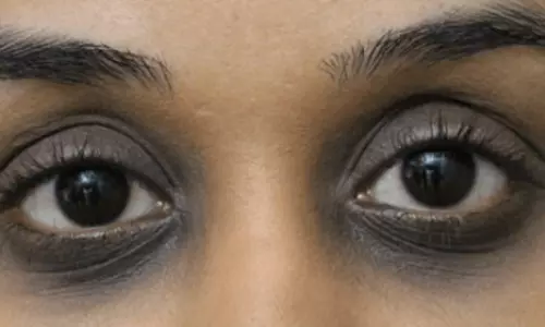 കണ്ണിനു ചുറ്റുമുള്ള കറുത്തപാടുകൾ മാറാൻ ഇതാ 5 വഴികൾ