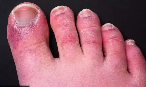 എന്താണ് കോവിഡ് ടോ?; അറിയാം കോവിഡ് ടോയുടെ പ്രധാന കാരണങ്ങൾ