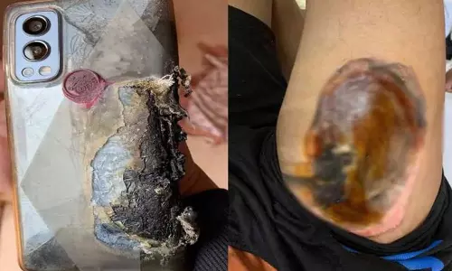 സ്മാർട് ഫോൺ പൊട്ടിത്തെറിച്ച് ഗുരുതരമായി പൊള്ളലേറ്റ യുവാവിന് വൺപ്ലസ് നഷ്ടപരിഹാരം നൽകി