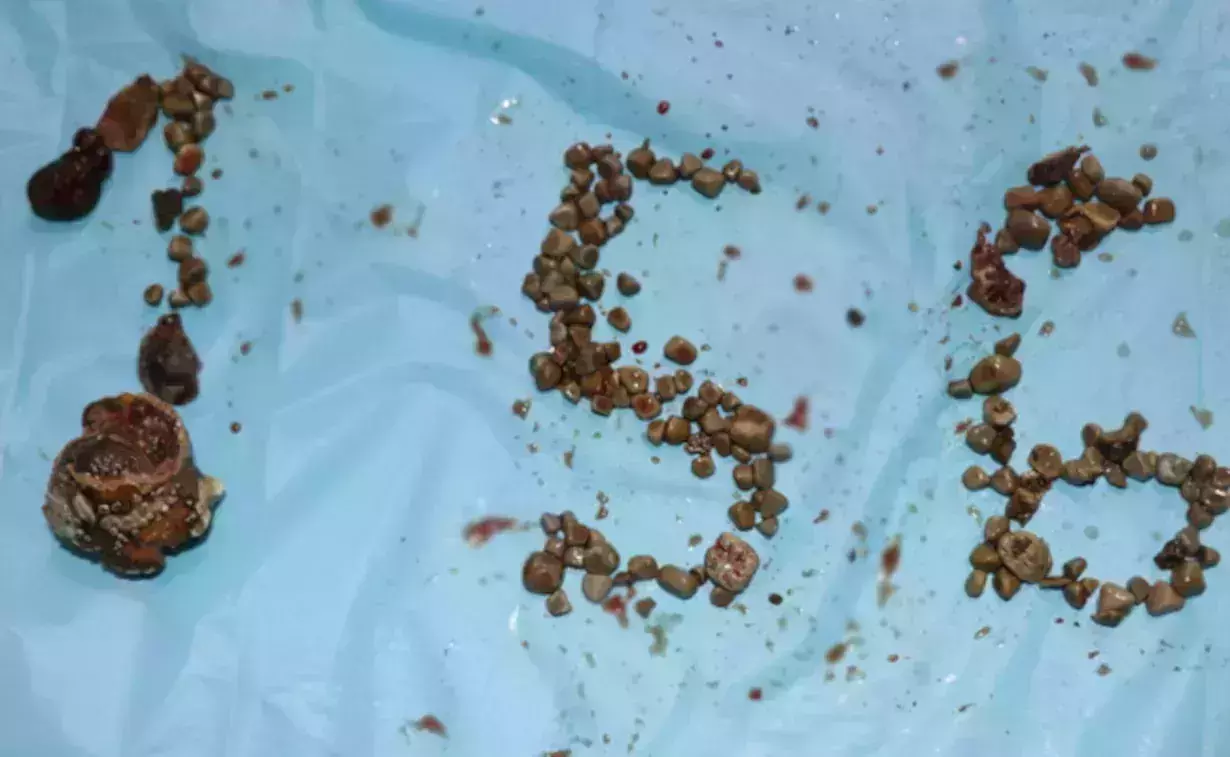 വൃക്കയില്‍ നിന്ന് പുറത്തെടുത്തത് 156 കല്ലുകള്‍; രാജ്യത്ത് ആദ്യമായി അപൂര്‍വ ശസ്ത്രക്രിയ