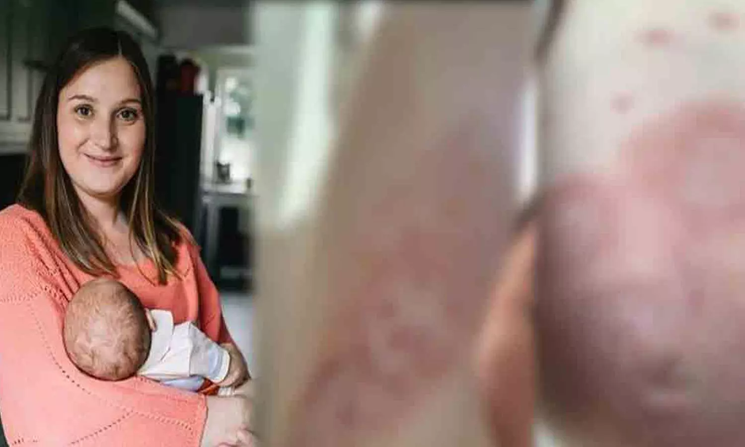 സ്വന്തം കുഞ്ഞിനെ തൊട്ടാല്‍ ശരീരം ചൊറിഞ്ഞു തടിക്കും;  അപൂര്‍വ രോഗാവസ്ഥയുമായി ഒരമ്മ