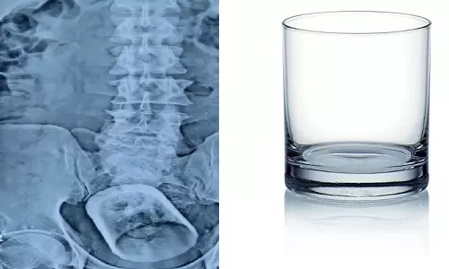 ചായ കുടിച്ചപ്പോൾ ഗ്ലാസ് വിഴുങ്ങിയെന്ന് 55 കാരൻ; ശസ്ത്രക്രിയ നടത്തിയപ്പോൾ ഞെട്ടി ഡോക്ടർമാർ