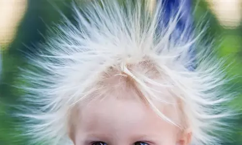 ഒരിക്കലും ചീകി വയ്ക്കാനാകാത്ത മുടി; അതായത് അൺകോമ്പബ്ൾ ഹെയർ  സിൻഡ്രോം