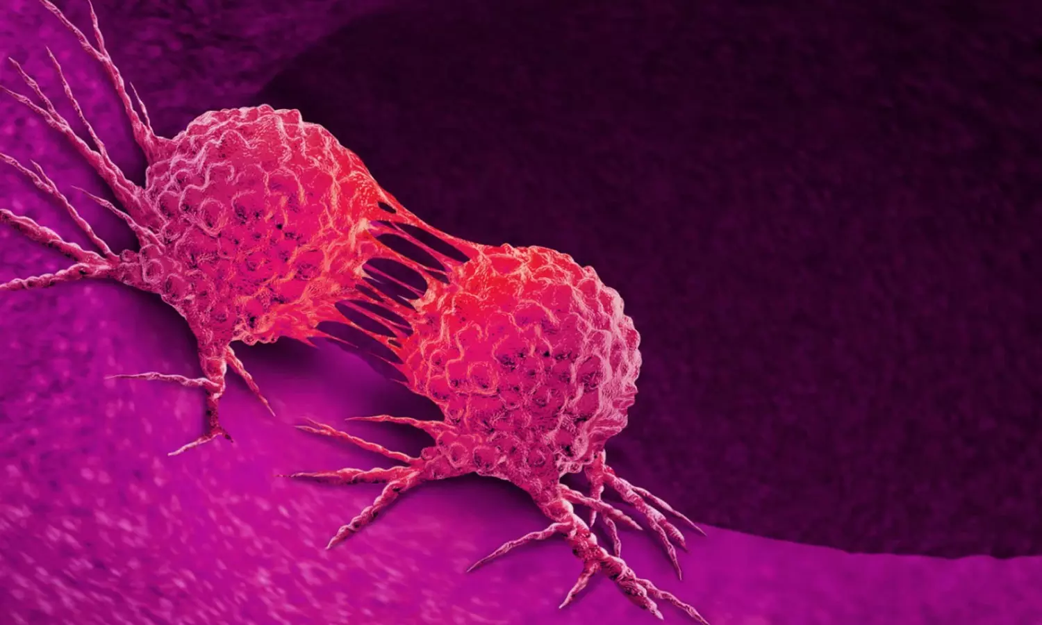 കുടലിൽ കാൻസർ വളരുന്നത് അറിയില്ല;ശ്രദ്ധിക്കണം ഈ ലക്ഷണങ്ങൾ