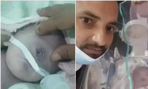 അപൂർവങ്ങളിൽ അപൂർവം; യെമനിൽ ഒരു കണ്ണുമായി പിറന്ന കുഞ്ഞ് മരിച്ചു