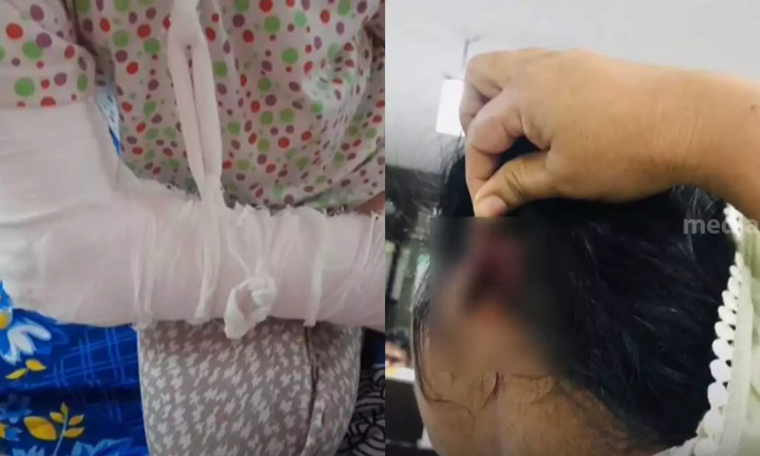 സൈക്കിൾ ചോദിച്ചതിന് പിതാവ് ഒൻപതു വയസുകാരിയുടെ ദേഹത്ത് ചൂടുവെള്ളമൊഴിച്ചു; ഭാര്യയുടെ ചെവി കടിച്ചുപറിച്ചു