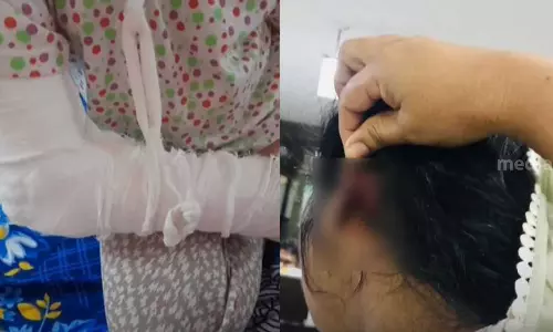 സൈക്കിൾ ചോദിച്ചതിന് പിതാവ് ഒൻപതു വയസുകാരിയുടെ ദേഹത്ത് ചൂടുവെള്ളമൊഴിച്ചു; ഭാര്യയുടെ ചെവി കടിച്ചുപറിച്ചു സൈക്കിൾ ചോദിച്ചതിന് പിതാവ് ഒൻപതു വയസുകാരിയുടെ ദേഹത്ത് ചൂടുവെള്ളമൊഴിച്ചു; ഭാര്യയുടെ ചെവി കടിച്ചുപറിച്ചു