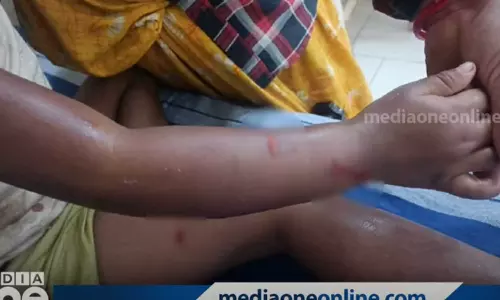 വാളയാറിൽ ഇതരസംസ്ഥാന തൊഴിലാളിയുടെ കുഞ്ഞിന് തെരുവുനായയുടെ കടിയേറ്റു