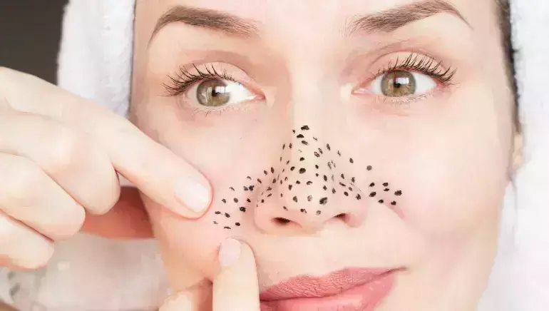 ബ്ലാക്ക് ഹെഡ്സ് ആണോ പ്രശ്നം? പരിഹാരമുണ്ട് ബ്ലാക്ക് ഹെഡ്സ് ആണോ പ്രശ്നം? പരിഹാരമുണ്ട്