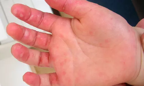 എന്താണ് തക്കാളിപ്പനി? ലക്ഷണങ്ങളും പ്രതിരോധ മാർഗങ്ങളും എന്താണ് തക്കാളിപ്പനി? ലക്ഷണങ്ങളും പ്രതിരോധ മാർഗങ്ങളും