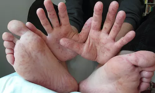 തക്കാളിപ്പനിയിൽ ആശങ്ക വേണോ? എന്താണ് ഹാൻഡ്-ഫൂട്ട്-മൗത്ത് ഡിസീസ്?