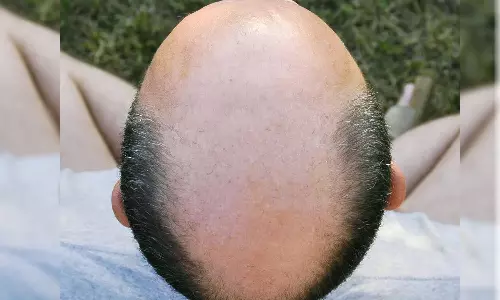 കഷണ്ടി എന്ന് വിളിച്ചാൽ ലൈംഗികാധിക്ഷേപം; ഉത്തരവിറക്കി യു.കെ ട്രിബ്യൂണൽ