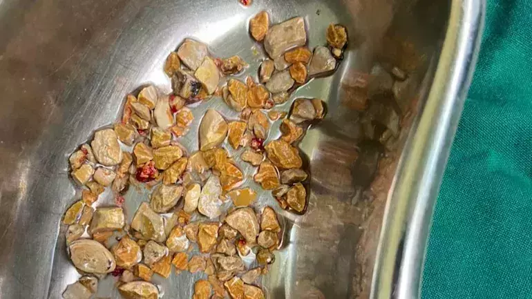 ഒരു മണിക്കൂര്‍ നീണ്ട ശസ്ത്രക്രിയ; 56കാരന്‍റെ വൃക്കയില്‍ നിന്നും പുറത്തെടുത്തത് 206 കല്ലുകള്‍