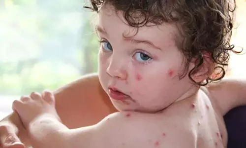 എന്താണ് തക്കാളിപ്പനി, ലക്ഷണങ്ങള് എന്തൊക്കെ? എന്താണ് തക്കാളിപ്പനി, ലക്ഷണങ്ങള് എന്തൊക്കെ?