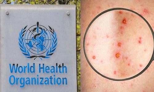 യൂറോപ്പിൽ കുരങ്ങുപനി പടരുന്നു;  അടിയന്തര യോഗം വിളിച്ച് ലോകാരോഗ്യസംഘടന