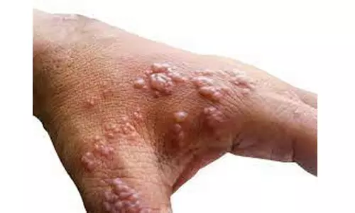 കോവിഡ് പോലെ പകരുമോ കുരങ്ങുപനി? തടയാൻ സ്വീകരിക്കേണ്ട മുൻകരുതലുകൾ