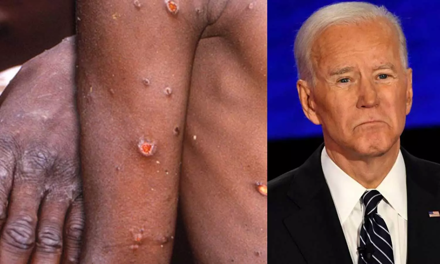 മറ്റൊരു മഹാമാരിയാകുമോ കുരങ്ങുപനി? ബൈഡന്റെ മുന്നറിയിപ്പ്