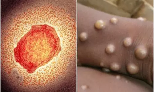 ഇസ്രായേലിലും കുരങ്ങുപനി; 12 രാജ്യങ്ങളിലായി 100 പേര്‍ പനിബാധിതരെന്ന് ലോകാരോഗ്യ സംഘടന