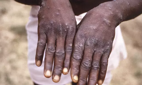 കുരങ്ങുപനി; രാജ്യത്ത് കർശന നിരീക്ഷണം  ഏർപ്പെടുത്താൻ നിര്‍ദേശം