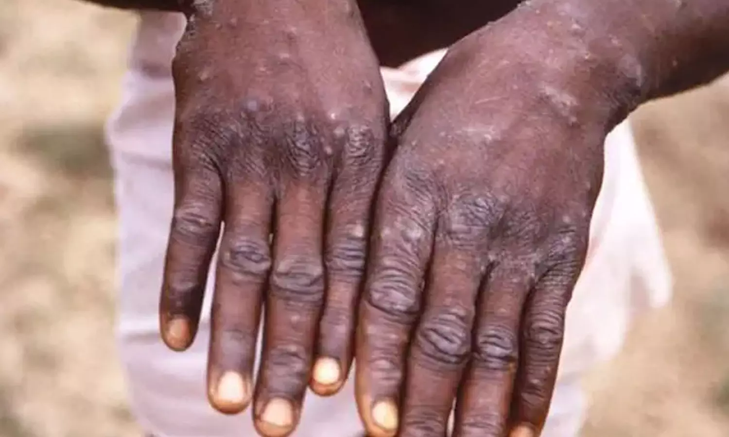 കുരങ്ങുപനി സ്ഥിരീകരിച്ച രാജ്യത്തുനിന്ന് വരുന്നവരെ പ്രത്യേകം നിരീക്ഷിക്കും; സംസ്ഥാനങ്ങൾക്ക് മാർഗനിർദേശങ്ങൾ പുറപ്പെടുവിച്ച് കേന്ദ്രം കുരങ്ങുപനി സ്ഥിരീകരിച്ച രാജ്യത്തുനിന്ന് വരുന്നവരെ പ്രത്യേകം നിരീക്ഷിക്കും; സംസ്ഥാനങ്ങൾക്ക് മാർഗനിർദേശങ്ങൾ പുറപ്പെടുവിച്ച് കേന്ദ്രം