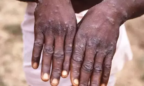 കുരങ്ങുപനി സ്ഥിരീകരിച്ച രാജ്യത്തുനിന്ന് വരുന്നവരെ പ്രത്യേകം നിരീക്ഷിക്കും; സംസ്ഥാനങ്ങൾക്ക് മാർഗനിർദേശങ്ങൾ പുറപ്പെടുവിച്ച് കേന്ദ്രം കുരങ്ങുപനി സ്ഥിരീകരിച്ച രാജ്യത്തുനിന്ന് വരുന്നവരെ പ്രത്യേകം നിരീക്ഷിക്കും; സംസ്ഥാനങ്ങൾക്ക് മാർഗനിർദേശങ്ങൾ പുറപ്പെടുവിച്ച് കേന്ദ്രം