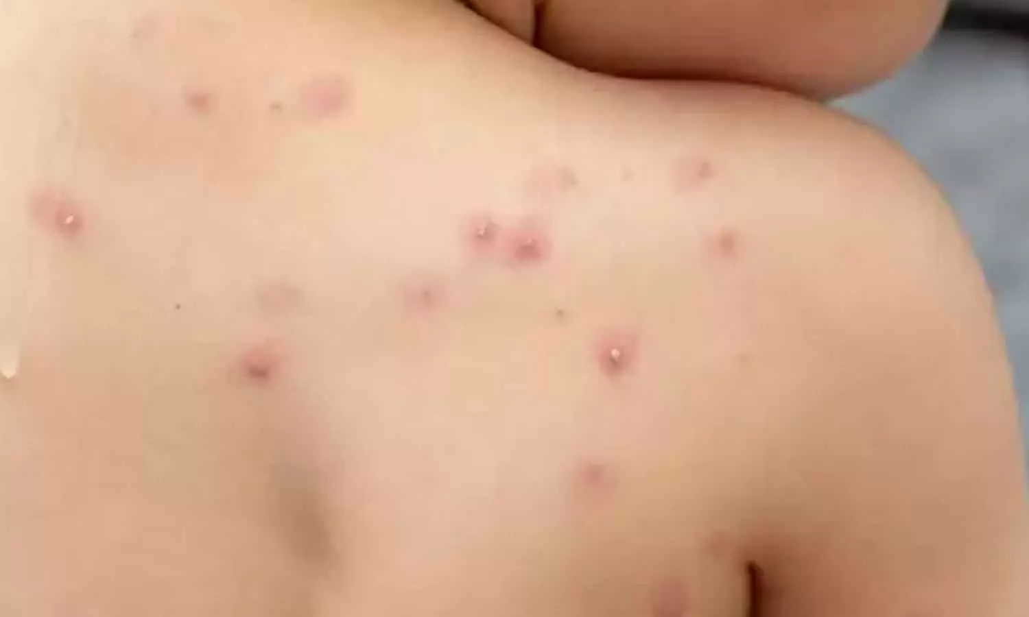 മലപ്പുറത്തും കുരങ്ങുവസൂരി; രോഗം സ്ഥിരീകരിച്ചത് യുഎഇയിൽനിന്ന് എത്തിയ ആൾക്ക്