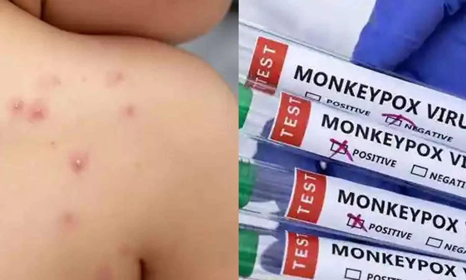 സൗദി അറേബ്യയിൽ കുരങ്ങുവസൂരി സ്ഥിരീകരിച്ചു