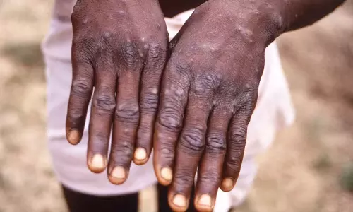 യുഎഇയിൽ അഞ്ച് കുരങ്ങ് വസൂരി കേസുകൾ കൂടി സ്ഥിരീകരിച്ചു