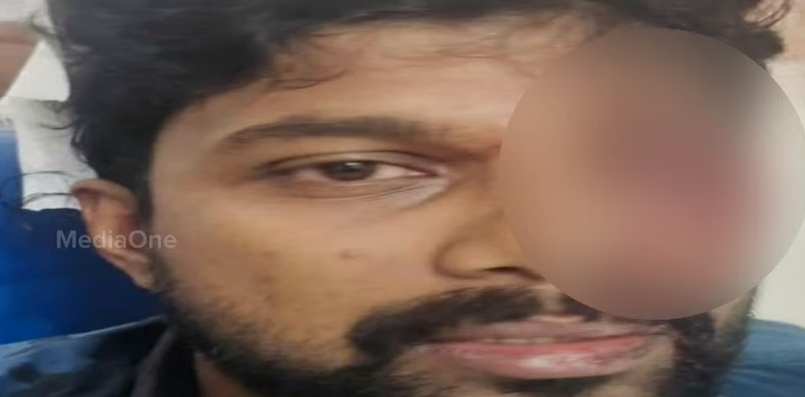 ഇടുക്കി യൂത്ത് കോൺഗ്രസ് ജില്ലാ സെക്രട്ടറി ബിലാൽ സമദിന് പൊലീസ് ലാത്തി ചാർജിൽ ഗുരുതര പരിക്ക്