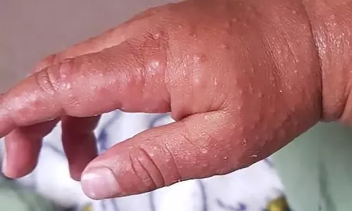 എന്താണ് ഹാന്‍ഡ്-ഫൂട്ട്-മൗത്ത് ഡിസീസ്?