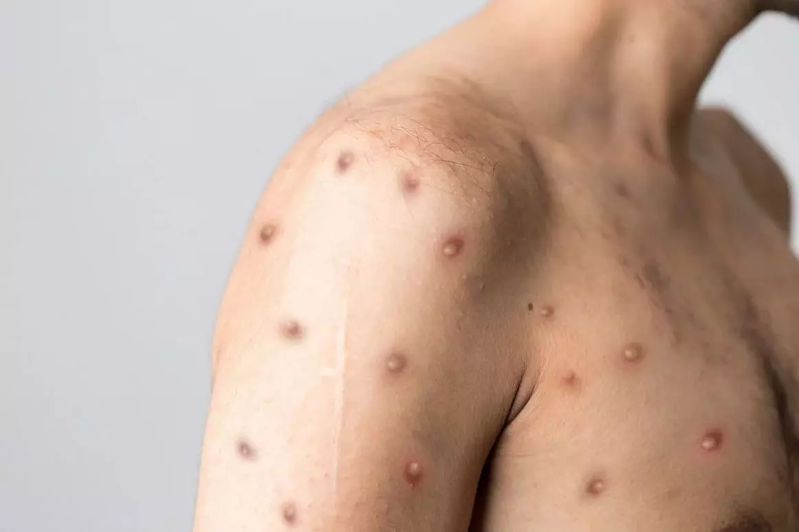 കേരളത്തിൽ കുരങ്ങുവസൂരി സ്ഥിരീകരിച്ചു; രാജ്യത്ത് ആദ്യ കേസ് കേരളത്തിൽ കുരങ്ങുവസൂരി സ്ഥിരീകരിച്ചു; രാജ്യത്ത് ആദ്യ കേസ്