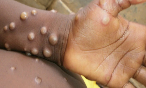 മങ്കിപോക്സ്: കേന്ദ്ര ഗവൺമെന്റ് കേരളത്തിലേക്ക് വിദഗ്ധ സംഘത്തെ നിയോഗിച്ചു മങ്കിപോക്സ്: കേന്ദ്ര ഗവൺമെന്റ് കേരളത്തിലേക്ക് വിദഗ്ധ സംഘത്തെ നിയോഗിച്ചു