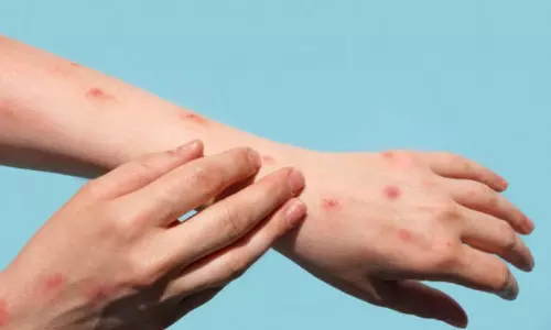 സൗദിയിലും വാനര വസൂരി; ജാഗ്രതാ നിര്‍ദേശവുമായി ആരോഗ്യ മന്ത്രാലയം.