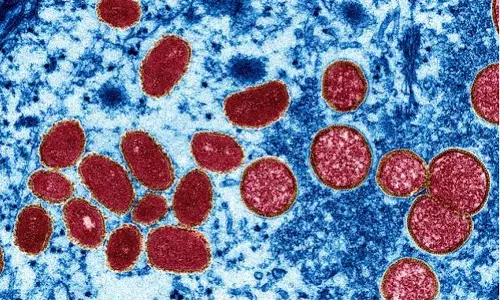 കുരങ്ങുവസൂരി; കണ്ണൂരിൽ യുവാവ് നിരീക്ഷണത്തിൽ