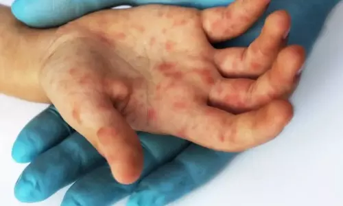 കുരങ്ങുവസൂരി; ചികിത്സയ്ക്കും നിരീക്ഷണത്തിനുമുള്ള എസ്.ഒ.പി പുറത്തിറക്കി