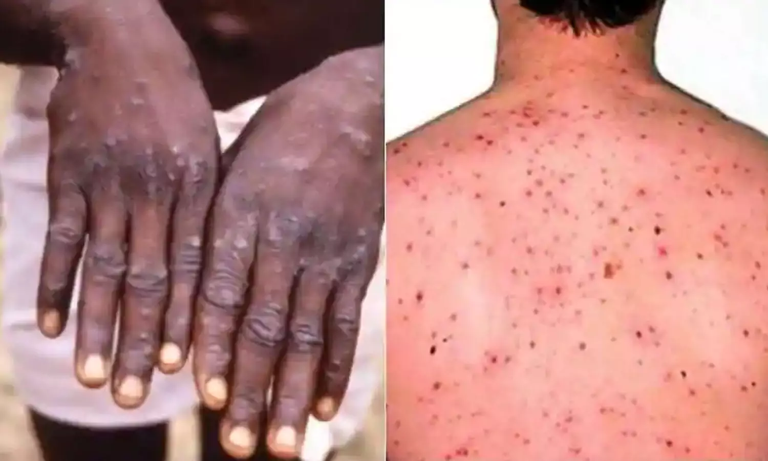 തൃശൂരിൽ കുരങ്ങുവസൂരി ആശങ്ക; രോഗ ലക്ഷണങ്ങളുള്ള കുട്ടി തൃശൂർ മെഡിക്കൽ കോളേജിൽ നിരീക്ഷണത്തിൽ തൃശൂരിൽ കുരങ്ങുവസൂരി ആശങ്ക; രോഗ ലക്ഷണങ്ങളുള്ള കുട്ടി തൃശൂർ മെഡിക്കൽ കോളേജിൽ നിരീക്ഷണത്തിൽ