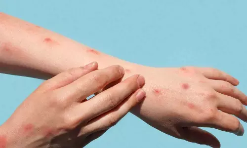 ഖത്തറിൽ കുരങ്ങുവസൂരി സ്ഥിരീകരിച്ചു