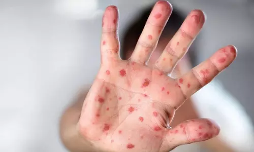 ലോകത്ത് കുരങ്ങു വസൂരി ബാധിക്കുന്നവരുടെ എണ്ണം കുതിച്ചുയരുന്നു