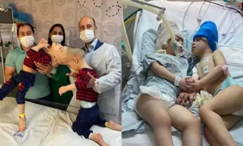 തലകൾ കൂട്ടിച്ചേർന്ന വിധത്തിൽ ജനിച്ച സയാമീസ് ഇരട്ടകൾ; 27 മണിക്കൂർ നീണ്ട ശസ്ത്രക്രിയയിലൂടെ വേർപെടുത്തി