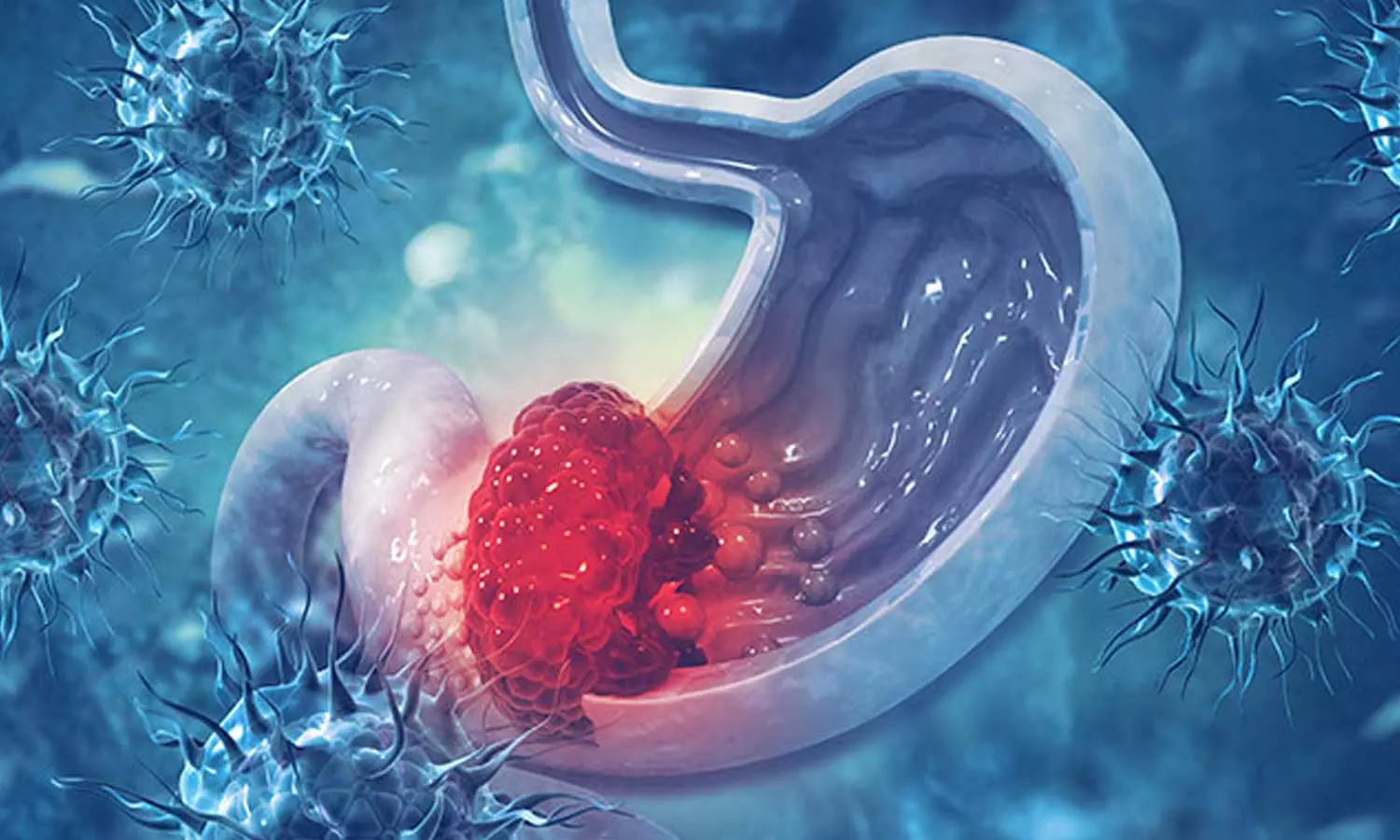 ആമാശയ കാൻസർ: ഈ ലക്ഷണങ്ങൾ അവഗണിക്കരുത്