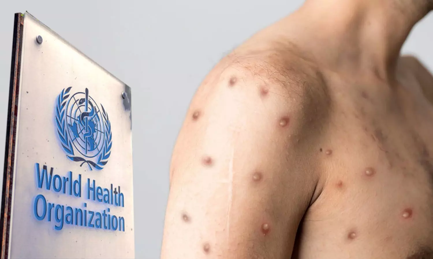 കുരങ്ങുവസൂരിയുടെ പുതിയ പേര് ട്രംപ്-22; പരിഹാസ്യമായി ഒന്നുമില്ല, ജനം ആഗ്രഹിക്കുന്നതായി ലോകാരോഗ്യ സംഘടന കുരങ്ങുവസൂരിയുടെ പുതിയ പേര് ട്രംപ്-22; പരിഹാസ്യമായി ഒന്നുമില്ല, ജനം ആഗ്രഹിക്കുന്നതായി ലോകാരോഗ്യ സംഘടന